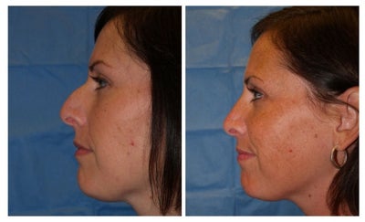 Rhinoplasty before and after photo