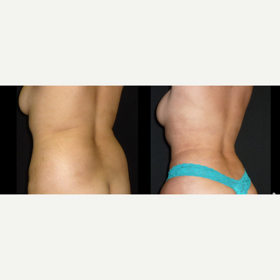 Liposuction before and after photo