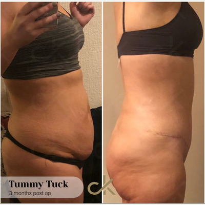 Tummy Tuck before and after photo