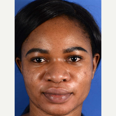 African American Nose Shapes