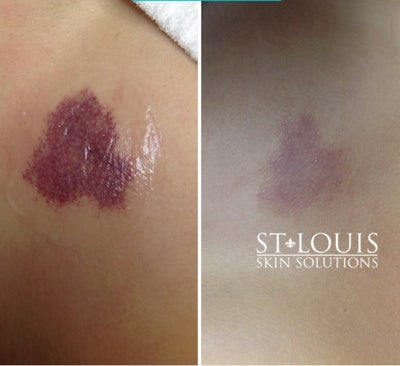 Laser Resurfacing before and after photo