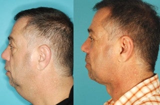 Chin Implant before and after photo