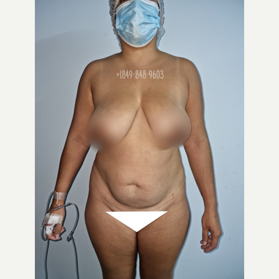 Will My Breast Implants Feel Real or Fake? - Fichadia