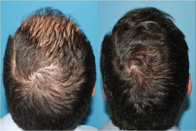 Hair Transplant before and after photo