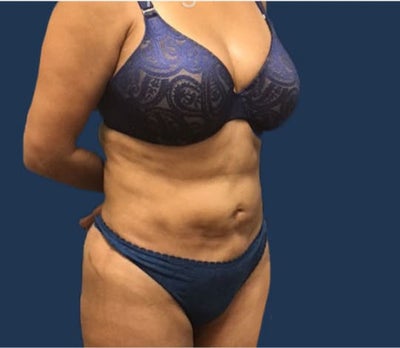 Would I Be a Good Candidate for a Mini Tummy Tuck? 
