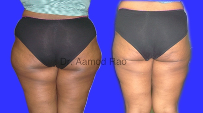 Liposculpture before and after photo