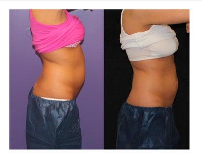 CoolSculpting before and after photo