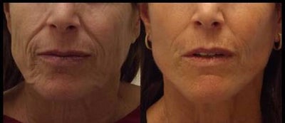 Facelift before and after photo