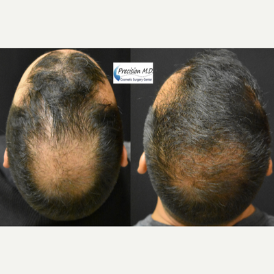 ARTAS Robotic Hair Transplant before and after photo