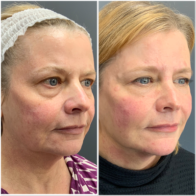 Dermal Fillers before and after photo