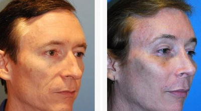 Brow Lift before and after photo