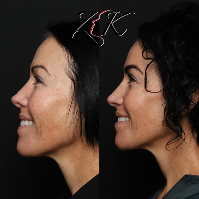 Revision Rhinoplasty before and after photo