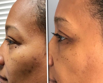Dermal Fillers before and after photo