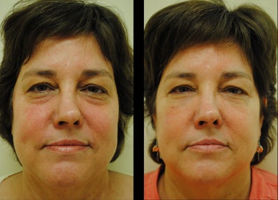 Juvederm before and after photo