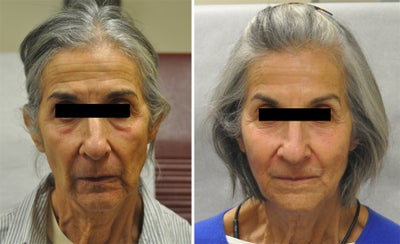 Juvederm before and after photo