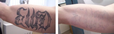 Tattoo Removal before and after photo