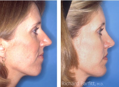 Chin Implant before and after photo