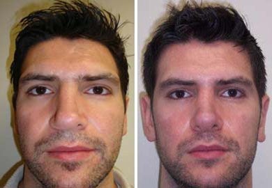 Revision Rhinoplasty before and after photo