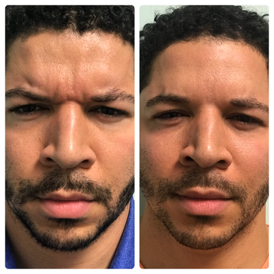 Xeomin before and after photo