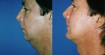 Genioplasty before and after photo