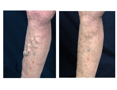 Sclerotherapy before and after photo