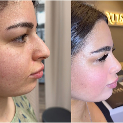 Rhinoplasty before and after photo