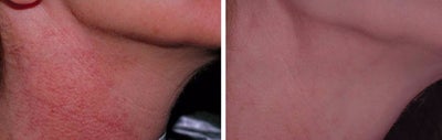 IPL before and after photo