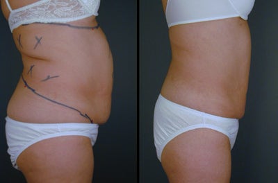 Liposculpture before and after photo