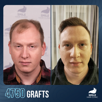 Hair Loss Treatment before and after photo
