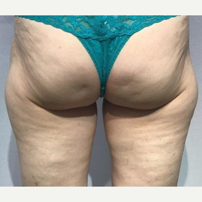 Cellfina Cellulite Treatment: Cost, Reviews, Treatment