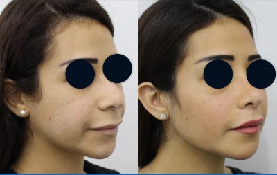 Facial Fat Transfer before and after photo