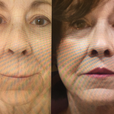 Lip Lift before and after photo