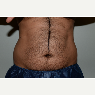 CoolSculpting Fat Freezing Treatments, Side Effects & Results