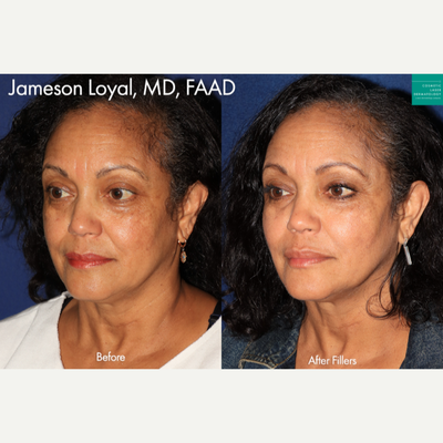 Dermal Fillers before and after photo