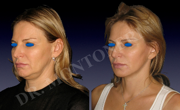 Mini Facelift before and after photo