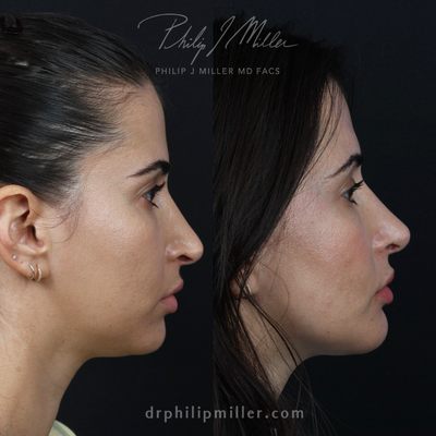 Chin Implant before and after photo