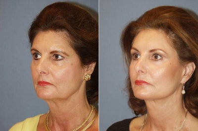 Brow Lift before and after photo