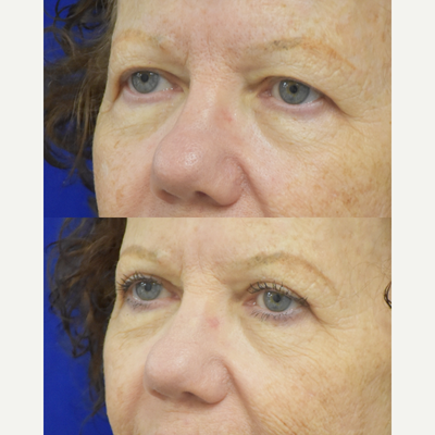 Brow Lift before and after photo