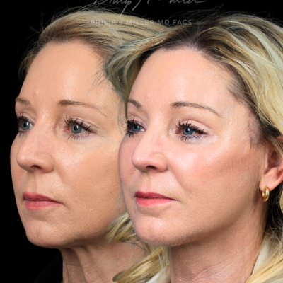 Facelift before and after photo