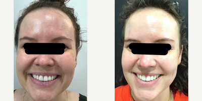 25-34 year old woman treated with Botox, Chemical Peel, HydraFacial - This client started a comprehensive treatment plan with a Hydrafacial, Enlighten Peel, Botox and another Hydrafacial to treat pigmentation, skin texture and wrinkles.