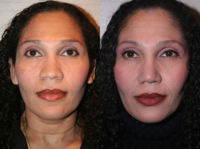 African American Rhinoplasty - 
	This women of african American descent desired a dramatic change in her nasal appearance. She wished to reduce her nasal boney width, lift and narrow her nasal tip, raise her bridge and narrow her nostrils. Results indicate a substantial improvement in nasal shape and proportion while maintaining a natural appearance.
