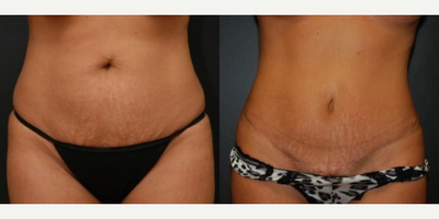 Woman treated with Mini Tummy Tuck - Woman treated with Mini Tummy Tuck- 4 months post-op