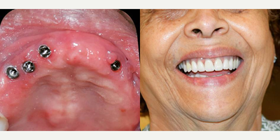 Woman treated with All-on-4 Dental Implants - Woman treated with All-on-4 Dental Implants
