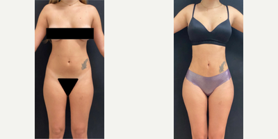 18-24 year old woman treated with Brazilian Butt Lift - 360 lipo Bbl. Patient wanted a natural look with a nicer silhouette.
