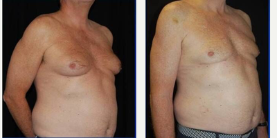 55-64 year old man treated with Power-Assisted Liposuction (PAL) - 55-64 year old man treated with Power-Assisted Liposuction (PAL) Bilateral Chest