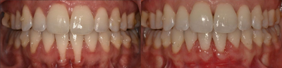 Woman treated with Dental Bone Graft - Woman treated with Dental Bone Graft
