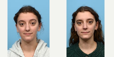 18-24 year old woman treated with Septoplasty - Looking to correct some breathing problems along with improving her nose shape, this 23-year-old patient turned to Dr. Wise for rhino-and septoplasty. Six weeks after the surgery, the patient loves her new nose and ability to breathe easy.
