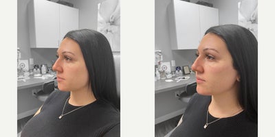 25-34 year old woman treated with Chin Filler - Looking to subtly add more definition to her cheeks and jawline, this patient opted for dermal fillers. After photos were taken immediately following treatment.