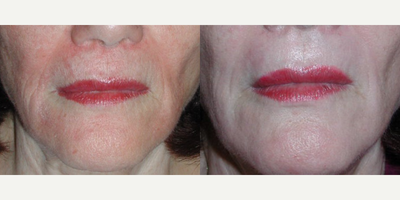 45-54 year old woman treated with VI Peel - The Vi Peel (Vitality Institute) is a gentle yet powerful medical-grade chemical peel for the treatment of acne and acne scarring, fine lines and wrinkles, age and sun spots, hyperpigmentation, melasma, rosacea, enlarged pores, oil balancing, and overall skin health.