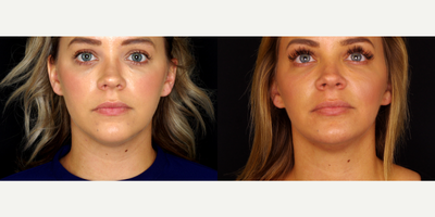 29 year old woman treated with Voluma - 29 year old woman treated with 2 syringes of Voluma. Photos depict before and 1 month after treatment.